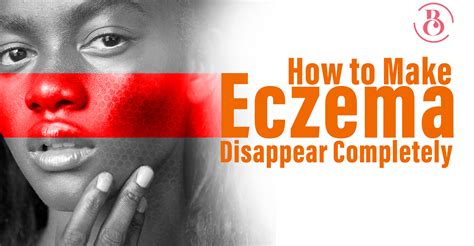 How To Make Eczema Disappear Completely Beaucrest