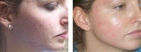 Acne Scar Laser Treatment Cosmetic Laser Institute 859