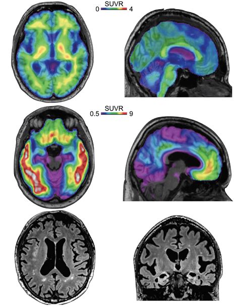 Alzheimers Disease Biomarkers Practical Neurology