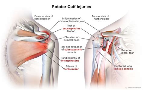 Rotator Cuff Injuries Medmovie Com