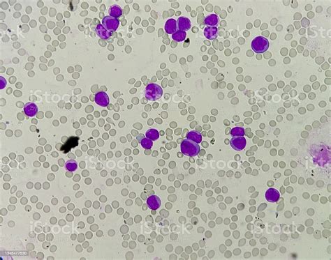 Blood Smear Microscopic Image Of Acute Mylohyoid Leukemia Stock Photo