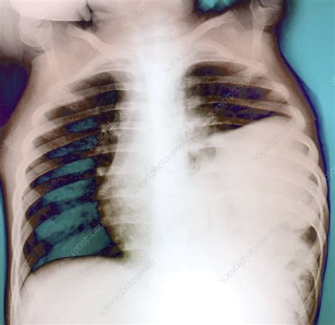 Diaphragmatic Hernia X Ray Stock Image C0041373 Science Photo