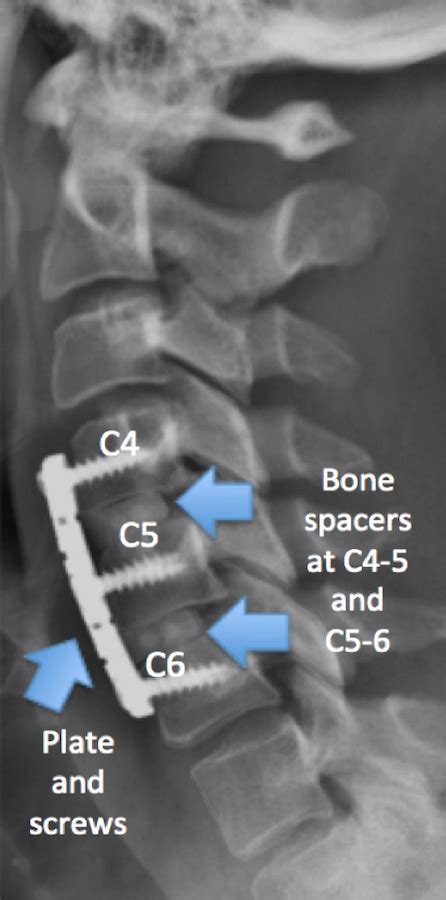 Acdf C5 C6 Anterior Cervical Discectomy And Fusion Stock Trial