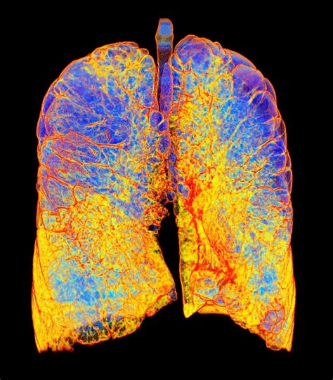 Smokers Lungs And Emphysema 3d Ct Scan Bild Kaufen 12642969