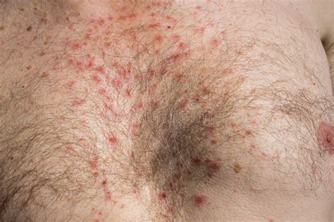 Chest Skin Rash As Drug Side Effect After Surgery Stock Image Image Of Sick Hairs 56752557