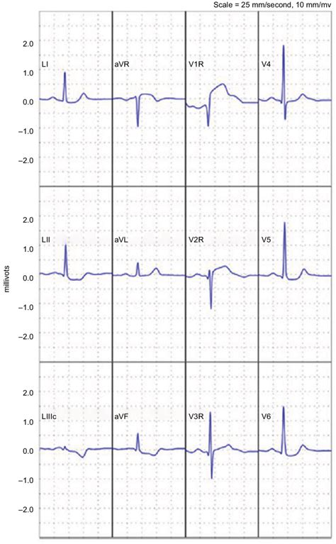 Reconstructed 12 Lead Electrocardiogram Demonstrating An St Elevation