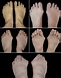 This picture illustrates various degrees of bunion deformity from mild ...