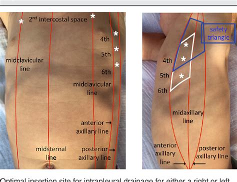 Figure From Pediatric Chest Tubes And Pigtails An Evidence Based