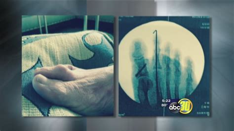 New Procedure For Hammertoe Surgery Helps Patients Recover Faster