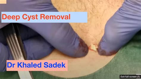 Deep Cyst Removal Dr Khaled Sadek LipomaCyst Com YouTube