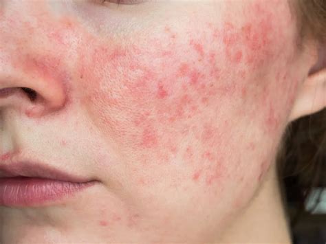 Different Types Of Rosacea And Treatments Skn Clinics
