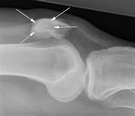 Bipartite Patella As Seen On A Lateral Knee Radiograph Normal Variant