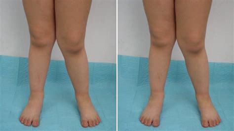 Knock Knees Know The Causes Symptoms And Prevention From Expert