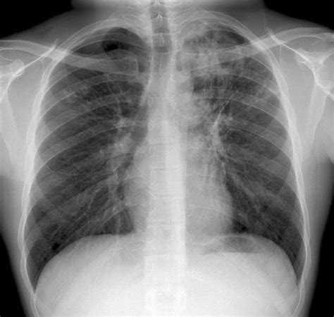Tuberculosis X Ray Photograph By Du Cane Medical Imaging Ltd Fine