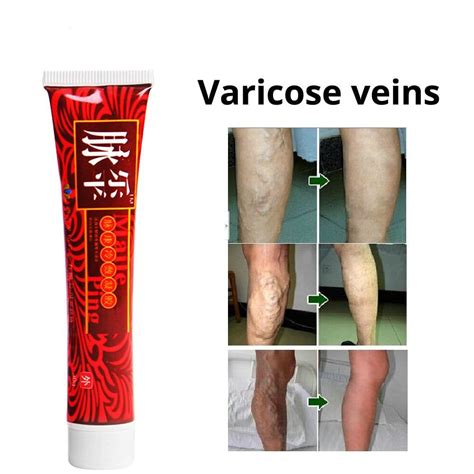 Varicose Veins Miracle Cream Cozexs Varicose Veins Miracle Cream