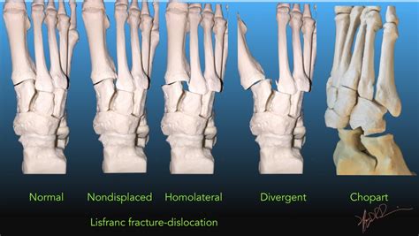 Midfoot Fracture Dislocations Uw Emergency Radiology