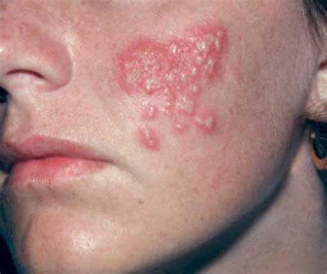 Herpes Simplex