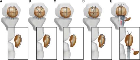 Extensor Mechanism Injuries Of The Knee Musculoskeletal Key