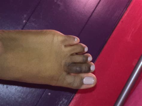 My Toe Got Blacker And Its Swollen I Dont Know What The Problem Is