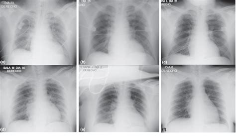 Serial Chest Radiographs Showed Significant Recovery In 2 Covid 19