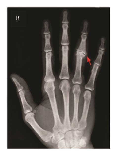 X Ray Of Right Hand Severe Degenerative Changes At The Fourth Pip