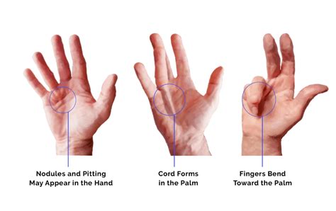 What Is Dupuytrens Contracture And How Can It Be Treated Bút Chì Xanh