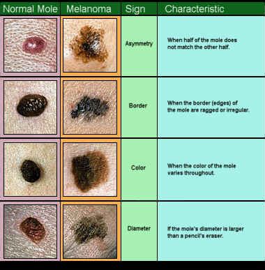 However, although the biopsy may help in staging cancer, it does not offer any survival advantage. Skin Cancer: Basal cell carcinoma, Squamous cell carcinoma ...