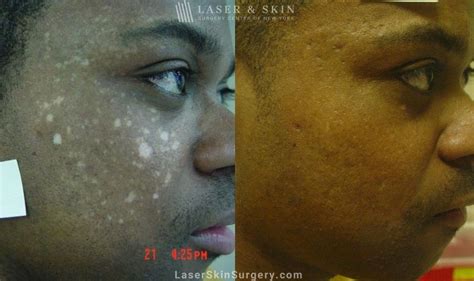 Hypopigmentation Skin Overview New York Ny Laser Center