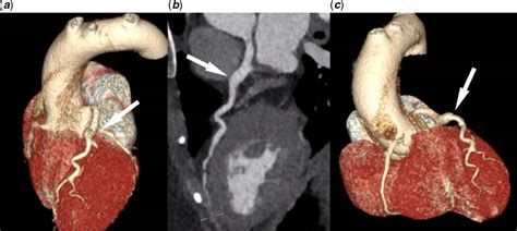 Coronary Aneurysm In A Young Patient With Turner Syndrome Cardiology