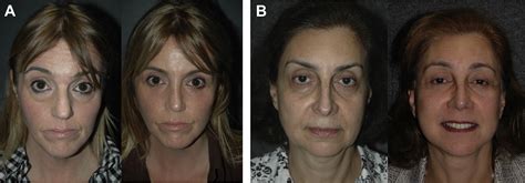 Transcutaneous Blepharoplasty With Volume Preservation Facial Plastic