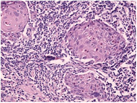 Islands Of Moderately Differentiated Squamous Cell Carcinoma With