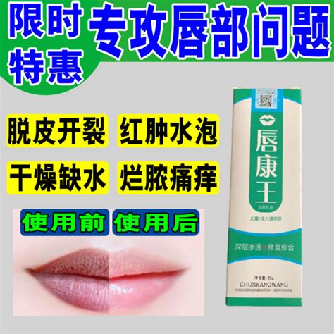 Cheilitis Chapped Lips Peeling Cheilitis Cream Lip Guard Rotten Corners