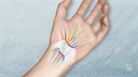 Mayo Clinic Minute Symptoms Solutions For Carpal Tunnel Syndrome