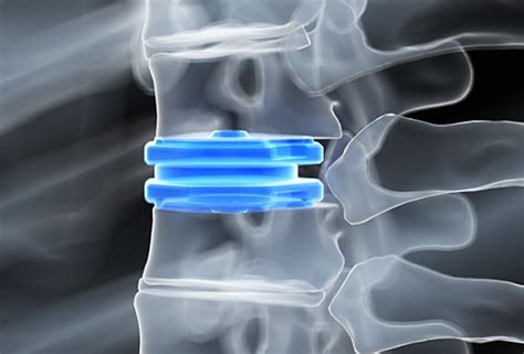 Disc Replacement Interventional Spine And Surgery Group