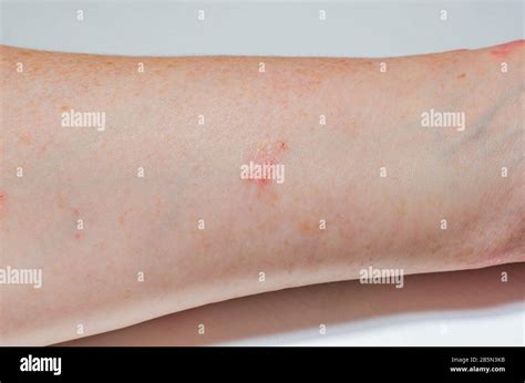 Allergic Skin Rash On The Inner Surface Of The Forearm Psoriasis