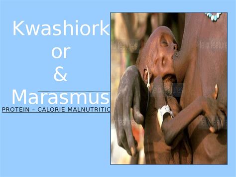 Ppp Kwashiorkor And Marasmus Malnutrition Diseases And Disorders