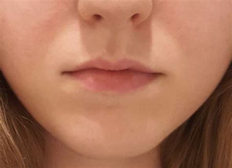 Um die lippen herum gibt es eine symptomfreie zone. Weiße blasse Haut um den Mund herum (siehe Foto ...