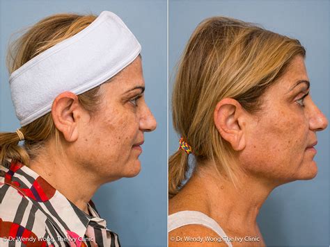 Cosmetic Before And After Gallery Dr Wendy Wong