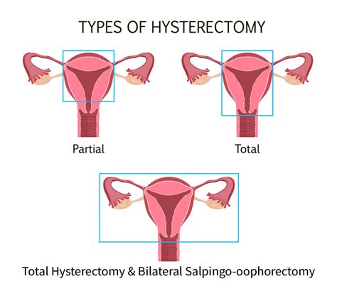 The Experts Weigh In Is A Hysterectomy An Effective Endometriosis Tre