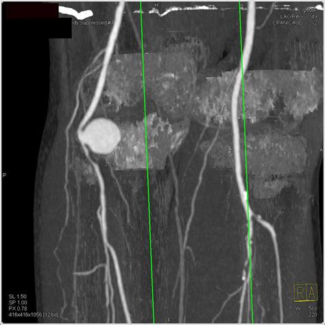 Popliteal Artery Aneurysm On Dual Energy Cta Vascular Case Studies