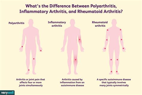 Polyarthritis Inflammatory Arthritis And Rheumatoid Arthritis