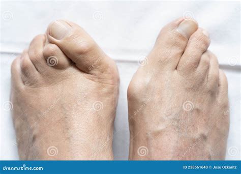 Male Feet Together With Big Bunions And Hammer Toes Stock Photo Image