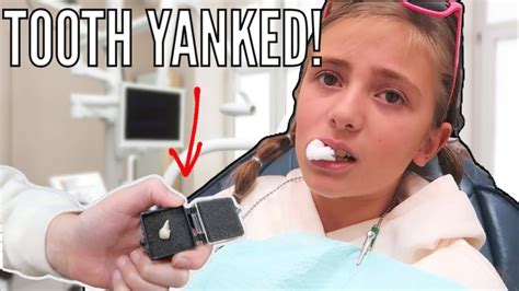 Tooth Yanked Out With Pliers 😮 Clearing Space For Braces Youtube