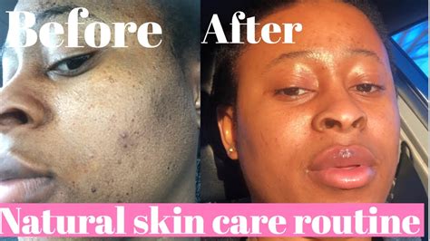 Skin care routine| natural skin care routine| home remedy| diy skin
