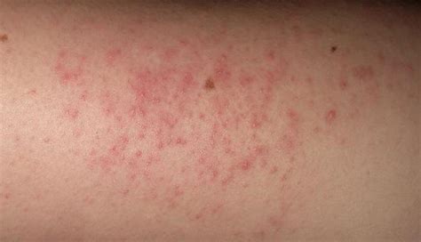 What Causes The Non Itchy Red Dots On Your Skin Enkiverywell