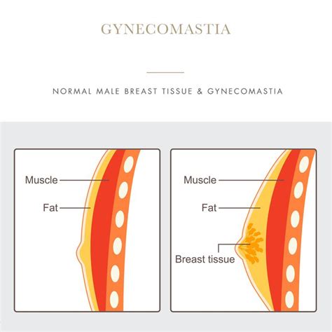 normal male breast tissue and gynecomastia