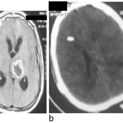 Stereotactic Ct For Left Thalamic Pilocytic Astrocytoma Download