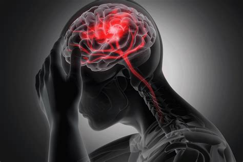 What Causes Headaches And Migraines Experts Think They Finally Know