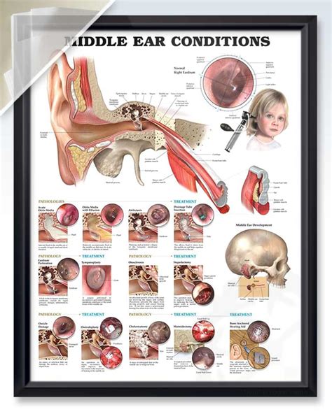 Middle Ear Conditions Discount Poster Clinicalposters