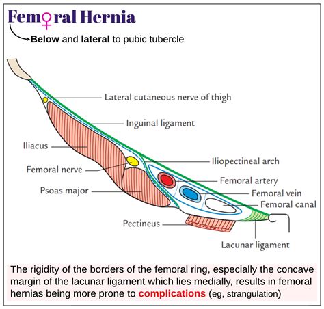 Femoral Hernia Medicine Keys For Mrcps
